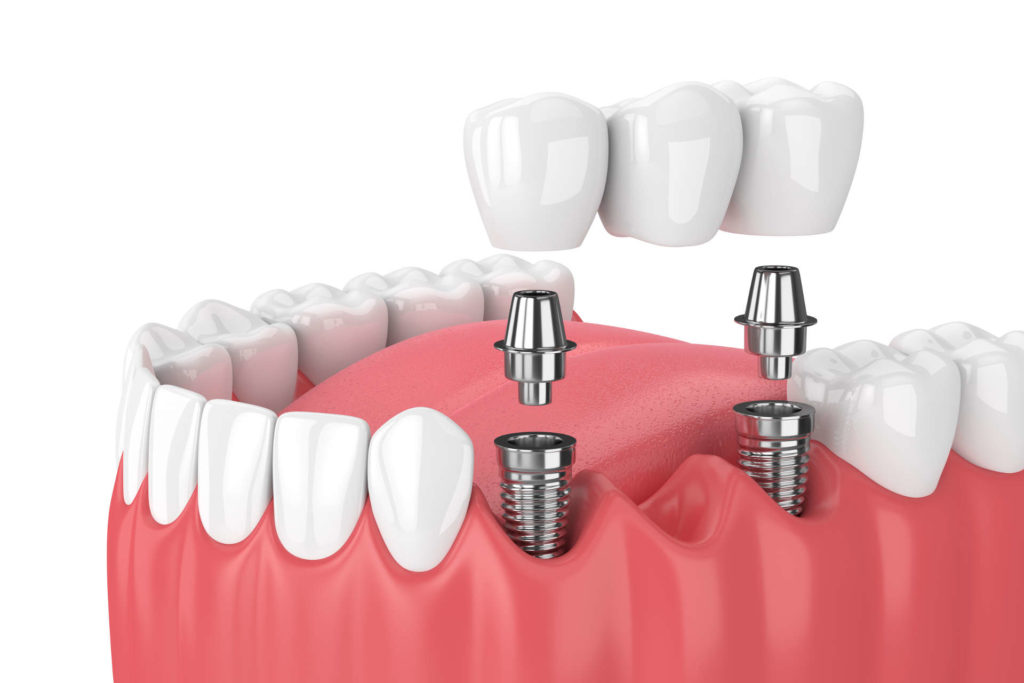 Dental Implants In US