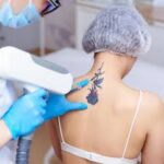 Understanding Mole and Tattoo Removal Techniques"